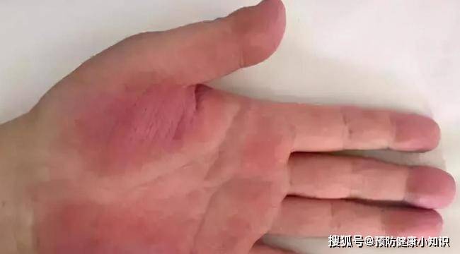 毒素|误认为皮肤过敏，查出肝癌！提醒：皮肤3种异常，肝或已“烂如蜂窝”