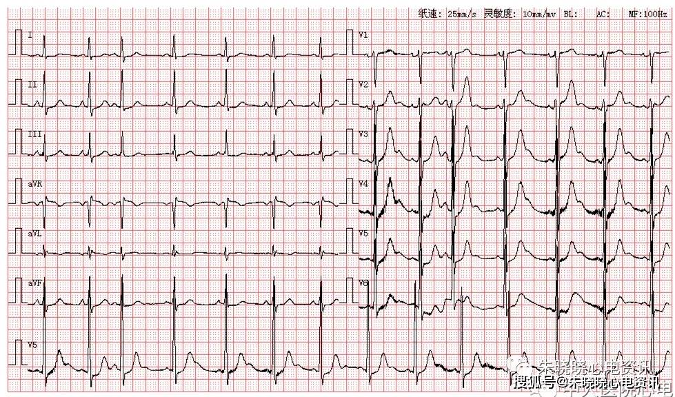 患者男,63歲,因胸悶心悸來醫院就診,有高血壓病史,圖為其入院體檢心電