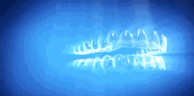 粘结|牙齿矫正科普：隐形矫正ｖｓ传统金属矫正