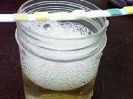 肾脏|为何“肾脏病”越来越多?提醒:3个指标得不到控制,会伤肾