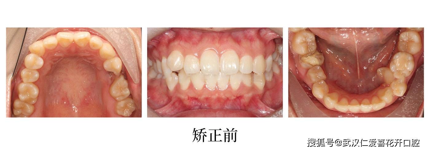 武汉仁爱口腔 牙列拥挤,牙槽骨严重吸收案例