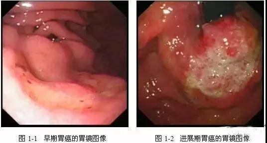 胃溃疡症状表现有哪些（胃溃疡症状表现有哪些吃什么养胃）-85模板网