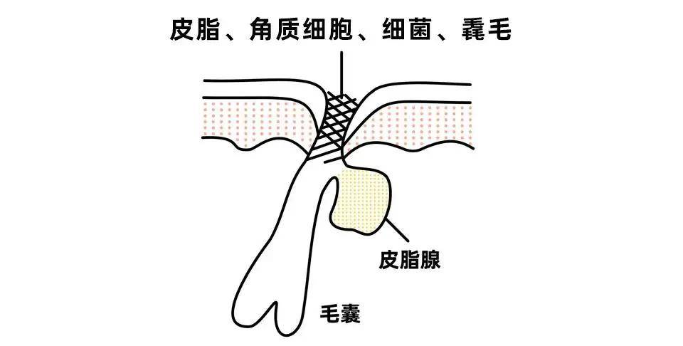 方法|如何正确去黑头，一文让你读懂！