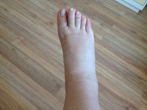 肝脏|脚是健康“晴雨表”?若出现三个迹象,多半是肝脏在向你“求救