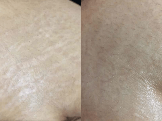 地方|肚皮长妊娠纹不美观！孕期做好这几点，基本就妥了，准妈妈看过