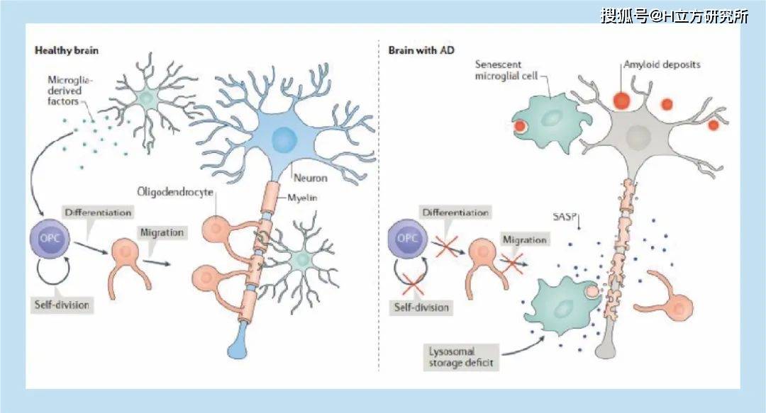 障碍|有关阿尔茨海默病，你需要知道的7件事