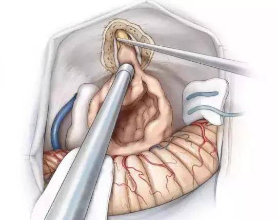 方向|只闻其声不解其意?耳鸣？切莫忽视听神经瘤的可能！