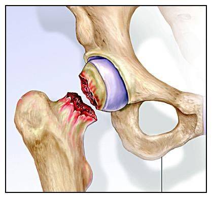 做好这几件事 降低外伤性股骨头坏死的发病几率!