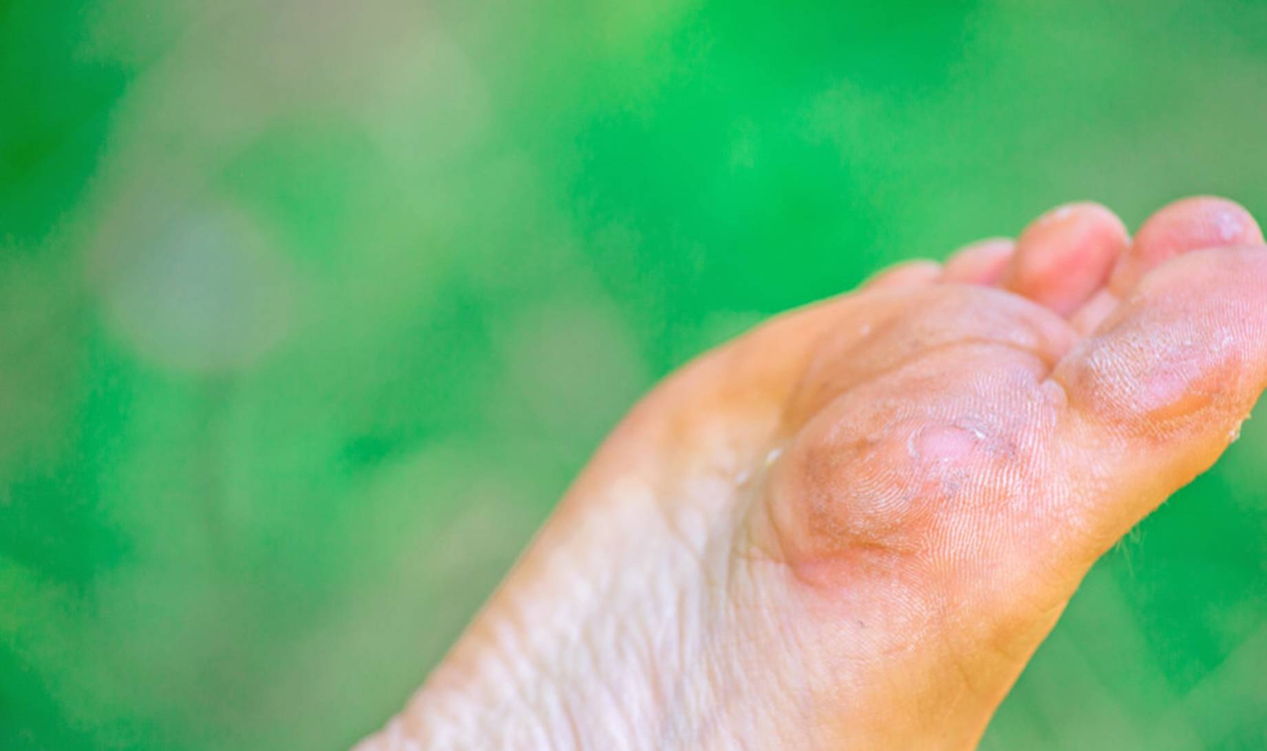 渔网|若脚上出现4个信号，肝已“烂如渔网”，尽快自查，不要忽视！