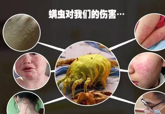 床上螨虫怎么清除小妙招 d5398cba6f3748f8b07677cc37735c6d.jpeg