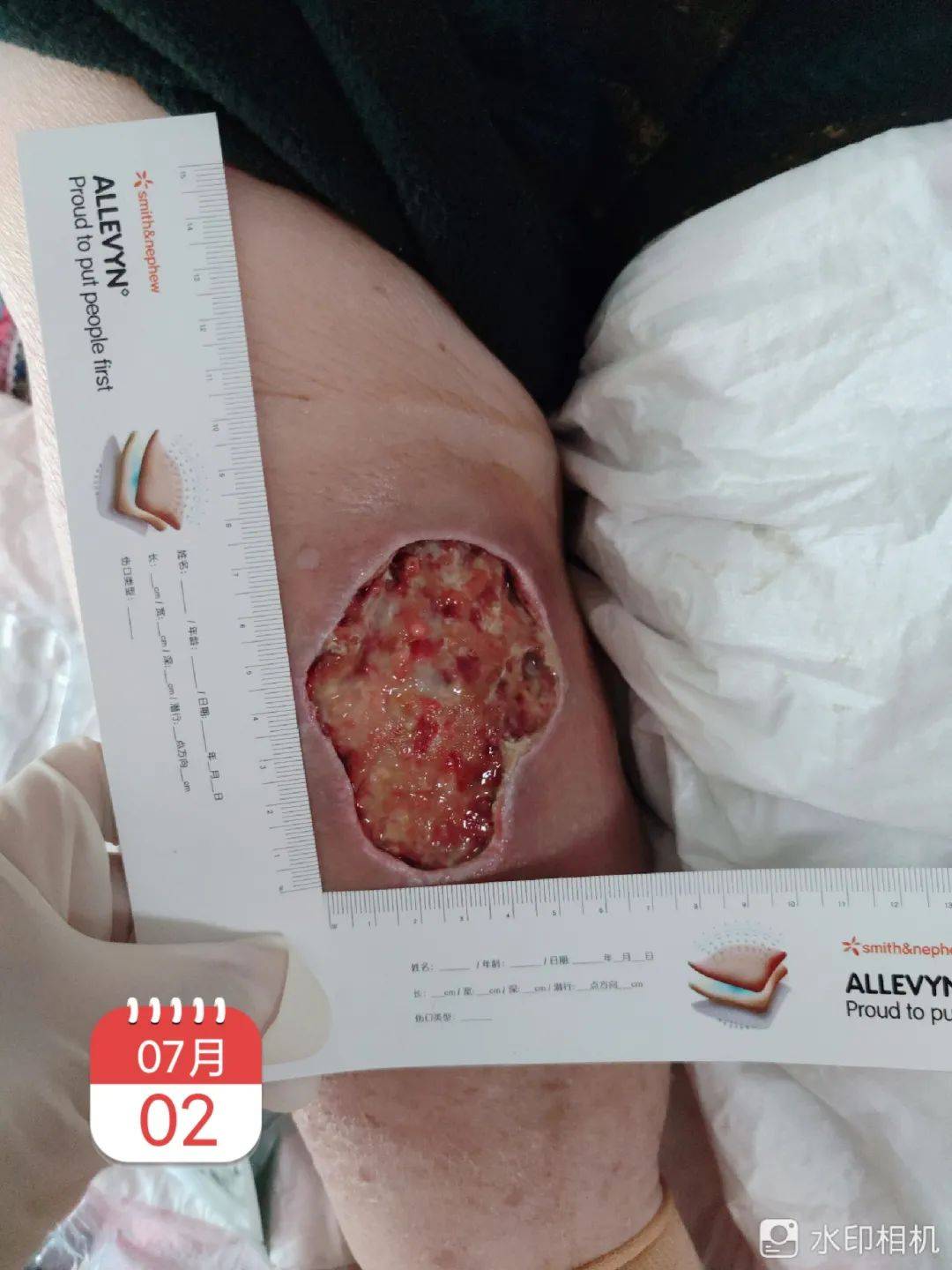 生理盐水冲洗,待干,外涂清创胶,潜行填塞藻酸盐,因赵奶奶伤口渗出特别