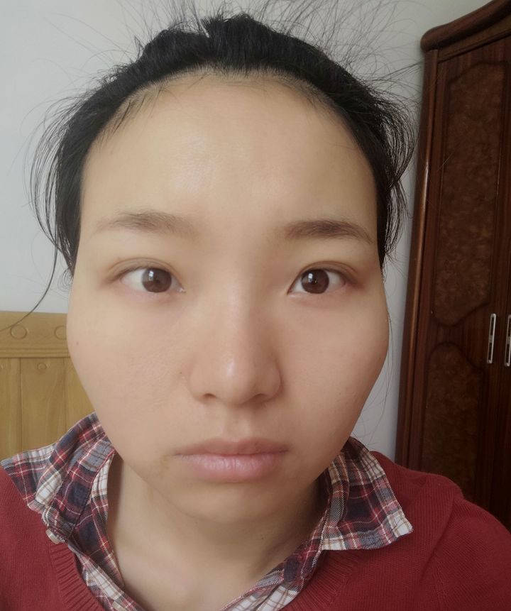 什么|面部抗衰 线雕适合哪些人做？禁忌是什么？线雕修复有多难？