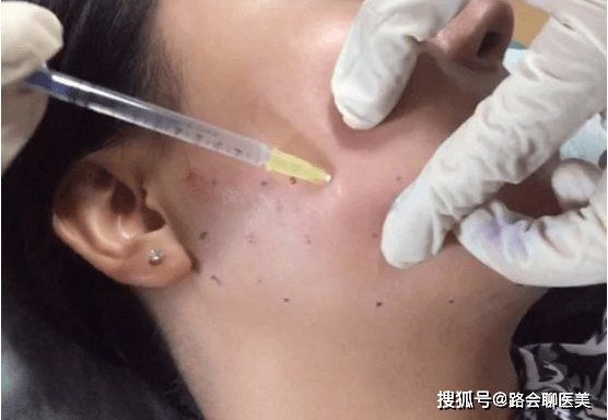 一针|颧骨高？一针“缩骨”，变成“黄晓明”？