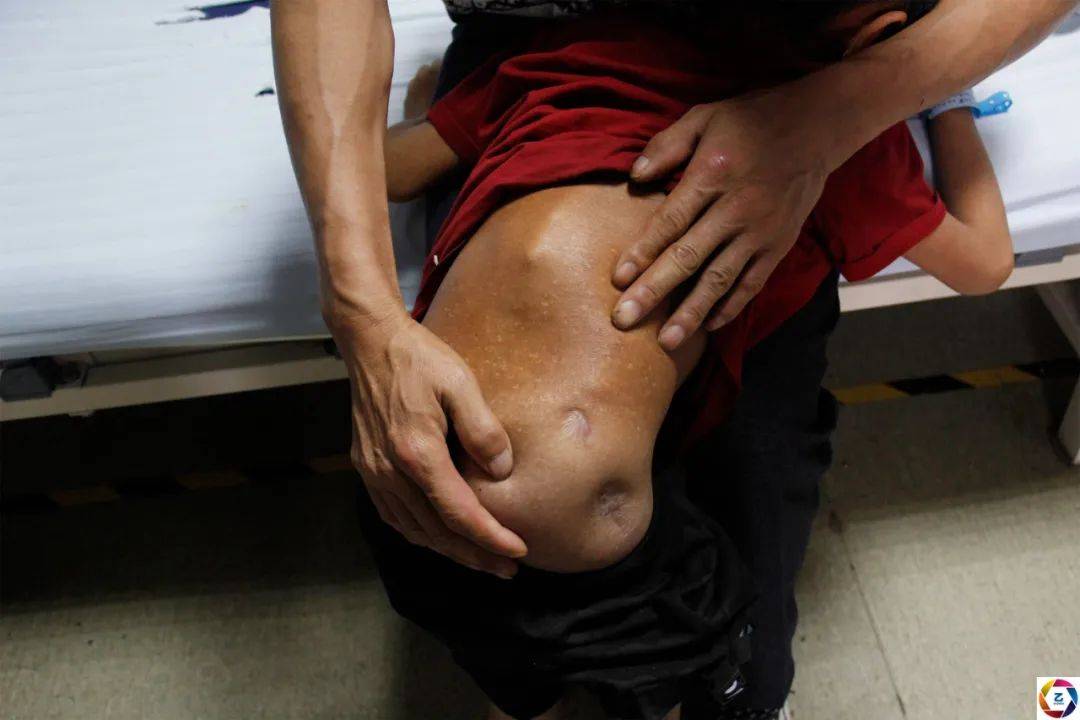 耳聋|男童骨折后不敢说导致残疾，妈妈离去，耳聋爸爸携其求医4年