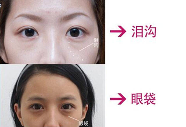 眼睛|有眼袋，20岁的小仙女也会被拖累成老阿姨！