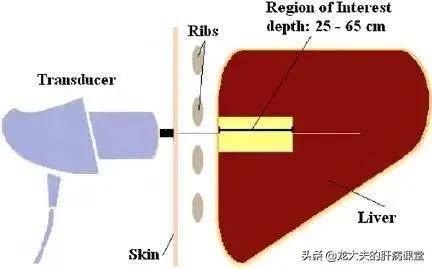 进行|肝弹数值高就是肝硬化吗？专家带您认识肝脏弹性指标！