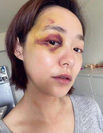 女星右眼大片淤血药师急打家暴专线带伤拍戏自揭家暴内幕