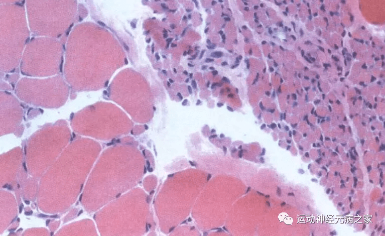 利鲁|运动神经元案例(肌萎缩侧索硬化最新治疗进展篇)