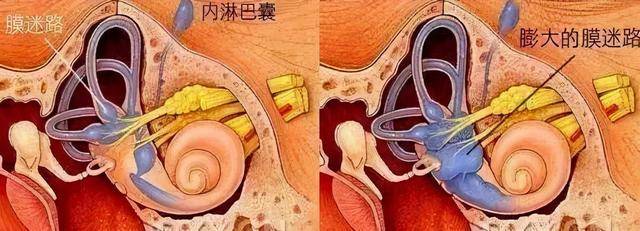 的耳源性眩暈疾病,其發病機制尚不明確,主要的病理改變為膜迷路積水