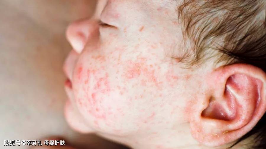 秋季天气干燥 皮肤瘙痒 湿疹又来找宝宝的麻烦了 成分 秋季天气干燥 皮肤瘙痒 湿疹又来找宝宝的麻烦了 成分