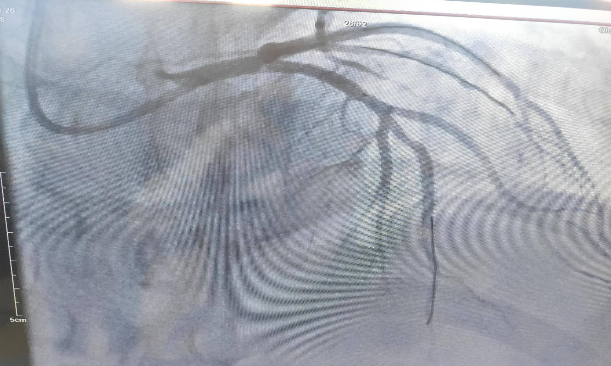 造影|45岁女性急性心梗，开始医生也有所怀疑，最后找到了原因