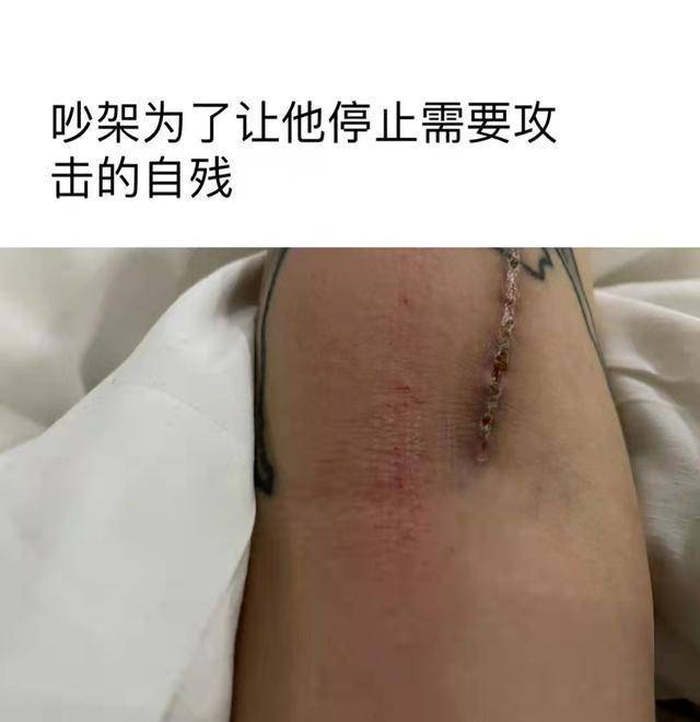 在配图当中,何婧婧晒出自己受不了家暴而自残的图片,在他的胳膊,大腿