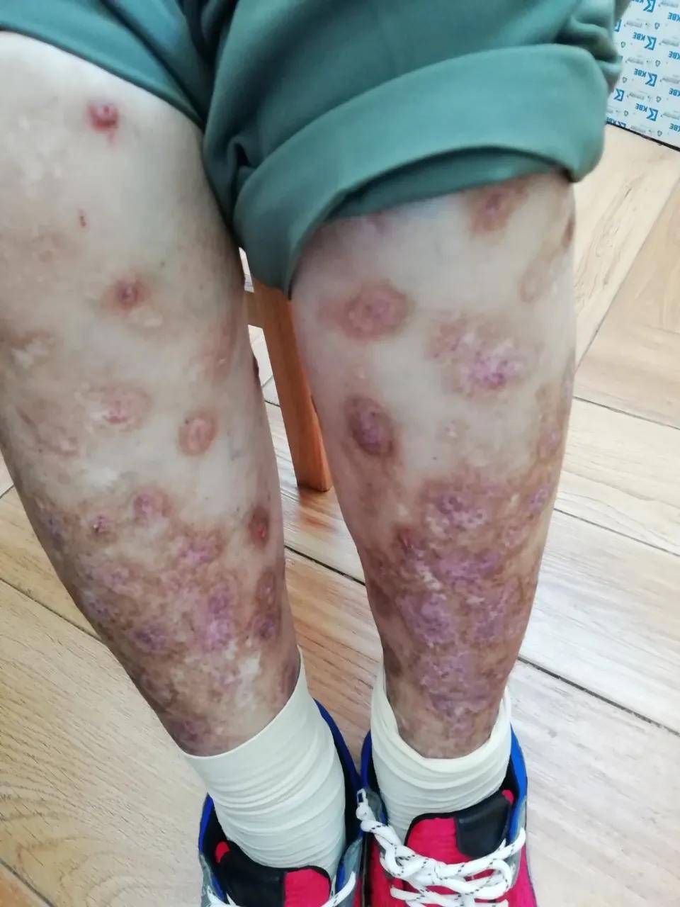 仁惠中医馆皮肤科外方专家胡爱玲主任治疗结节性痒疹有妙招