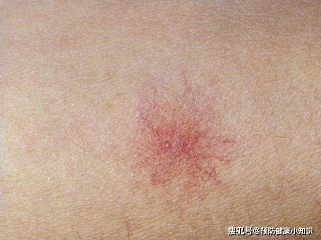 症状|46岁老李肝功能正常，却突然查出肝癌晚期？原来皮肤早有提醒