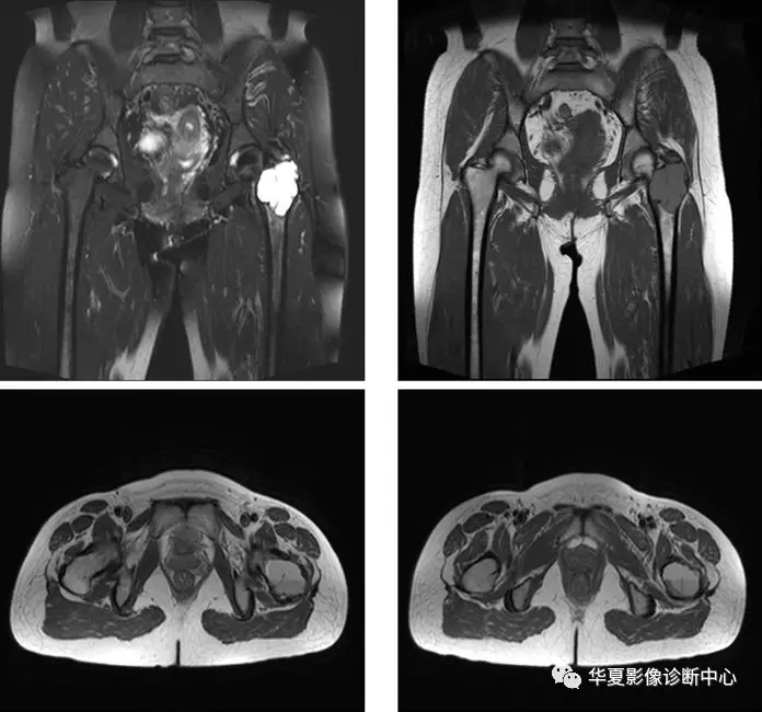 5,骨梗死:長管狀骨的骨梗死x線平片表現為呈圓形,橢圓形或不規則形狀