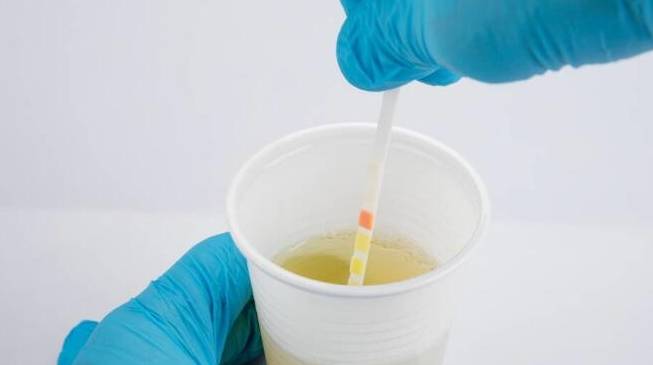 尿液|肾病好转，4项尿液指标会发信号，若都有先恭喜你