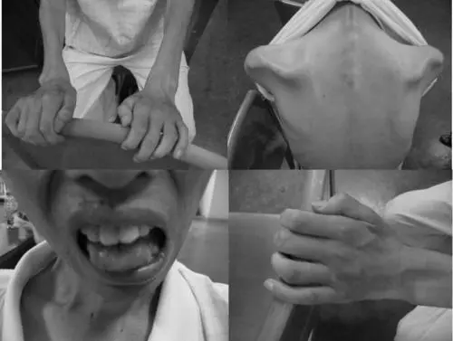 痉挛性|你知道运动神经元分为几种吗？你又是哪一种?