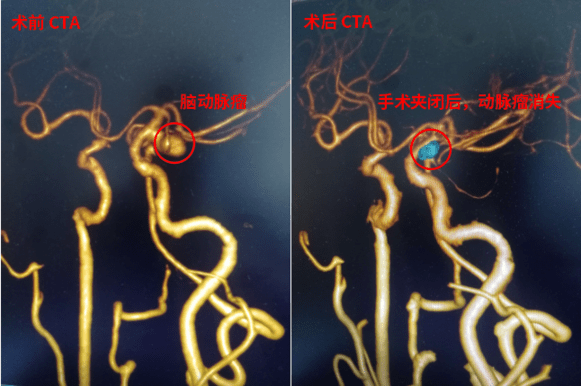 大妈洗澡意外摔倒发生脑出血 三博脑科孙玉明:留意这些预警信号