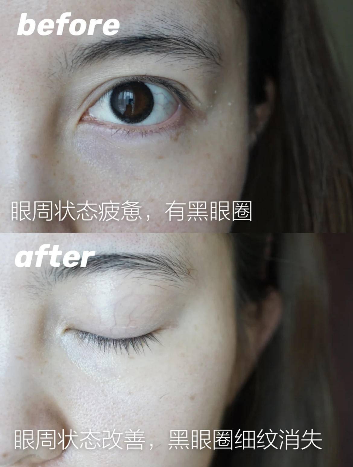 眼睛|眼膜真的有用吗？眼睛上的细纹有救了！