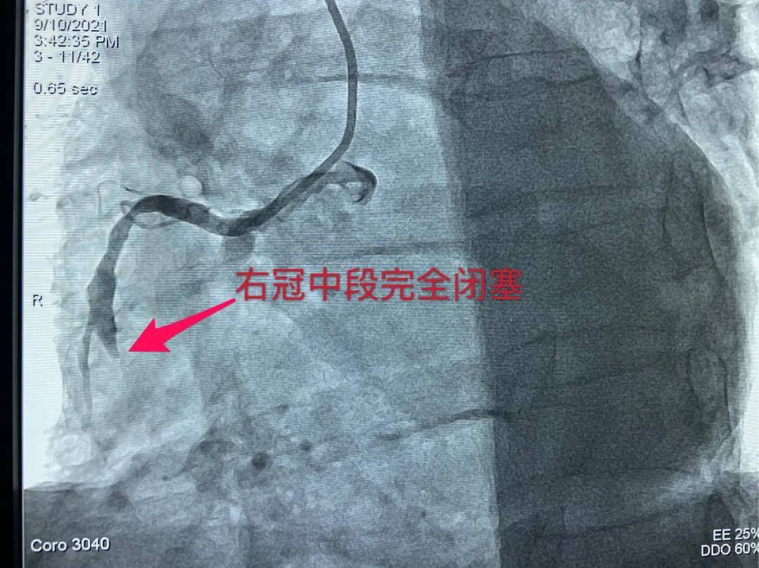 李逢春|丨急诊日记丨与死神竞速 同时间赛跑