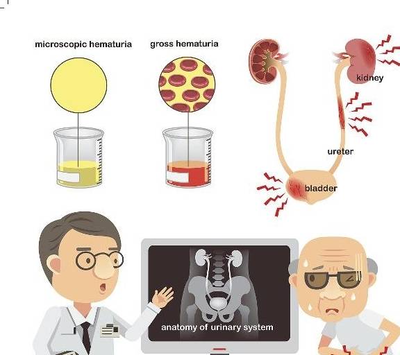 肾脏|肾结石太常见了?不想它“现身”,这3个很关键
