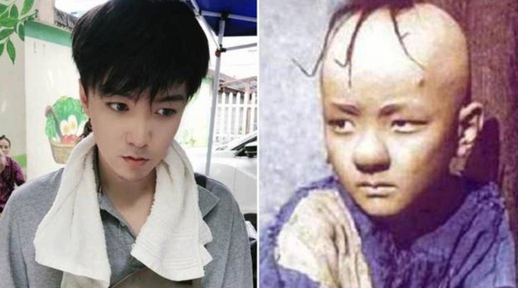 头皮|童星“三毛”因剃光头损坏毛囊，头顶缝300多针，现帅到认不出