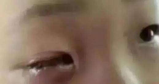 因为|20分钟可致失明!医生说这东西每家都有(家长们快收藏)