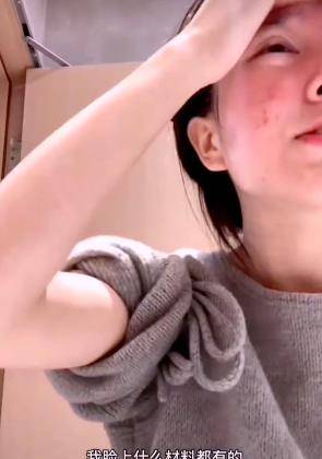 化妆品小霸宠首次透露素颜直播原因，审美跟大家不同，觉得满脸痘很好看
