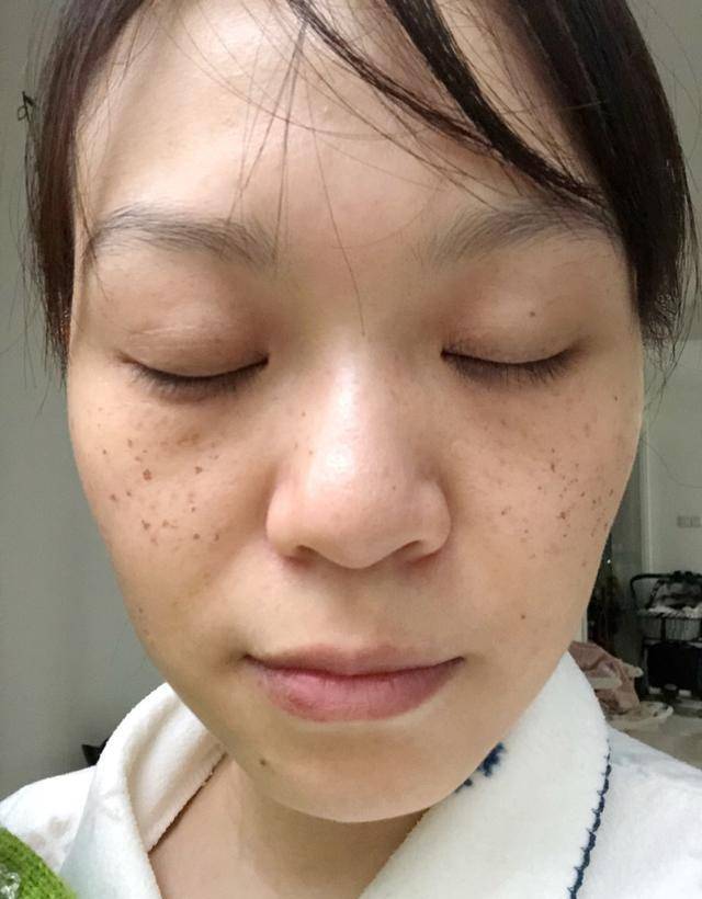 雀斑山东大姐为了淡斑美白，每天坚持喝一杯西红柿汁，结果怎样了？