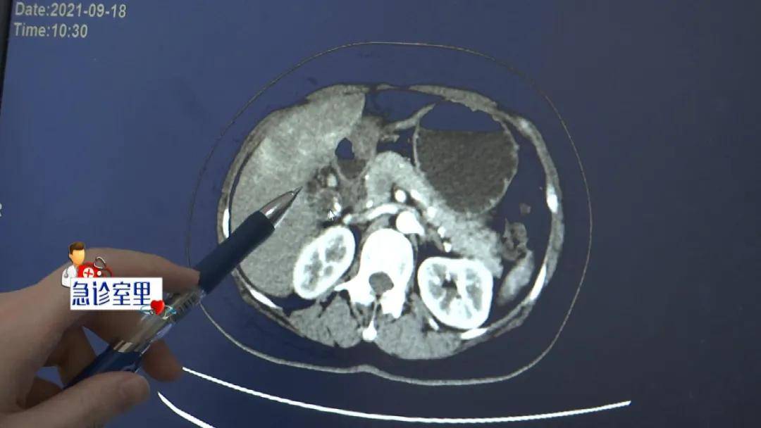 手术|上腹疼痛20天，检查结果让人震惊！患胆结石未引起重视，竟发展成癌……