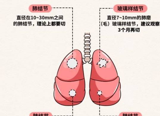 如何预防肺部小结节 9d3cdada702e4263b3c9150f3e1e4833.jpeg
