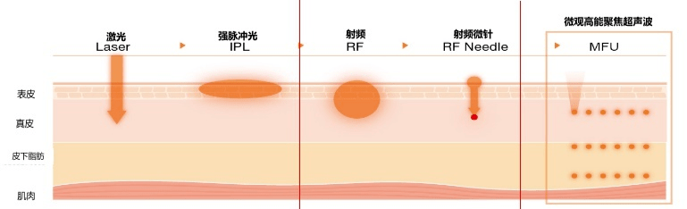 玛吉|采美小科普：7D聚拉提与声波、射频类仪器有什么区别？