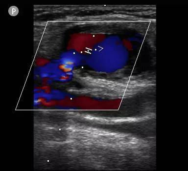 血管|神经血管介入中心联合超声科完成超声引导下凝血酶注射治疗假性动脉瘤