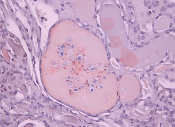 水平|蛋白尿最多的3类肾病,预后怎么样?如何防治?最全解读