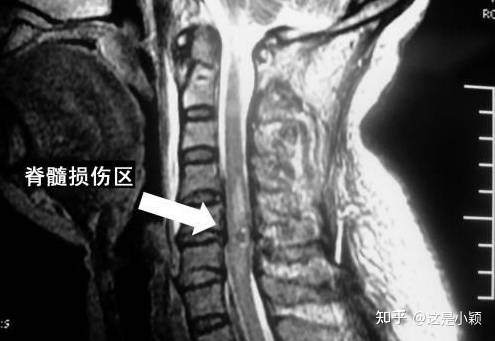 李慧英大夫 脊髓病变危害大 三大症状警惕你 治疗