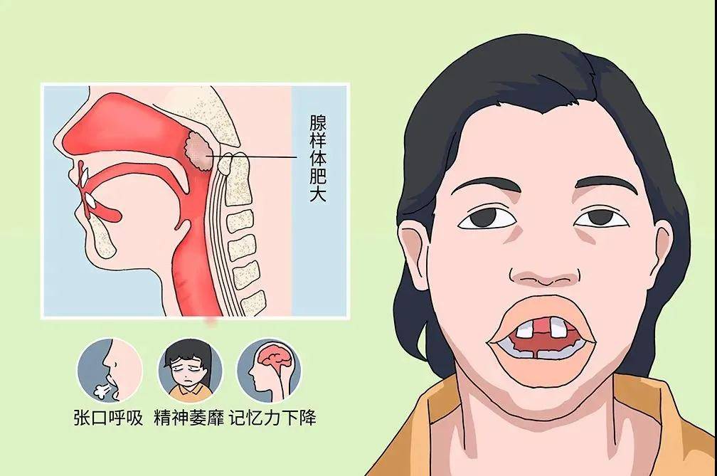 打鼾.通常因为气流通过狭窄的气道而导致打鼾或呼吸音粗重2.