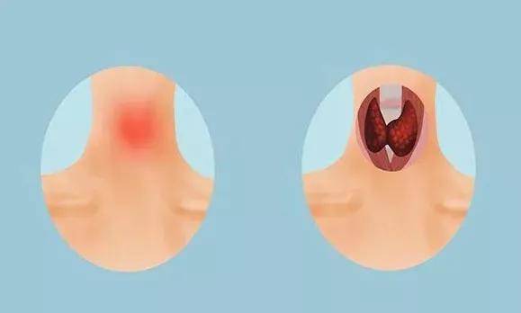 诊断|张先慧主任分享：容易被误诊的亚甲炎，你正处于哪个病情阶段？