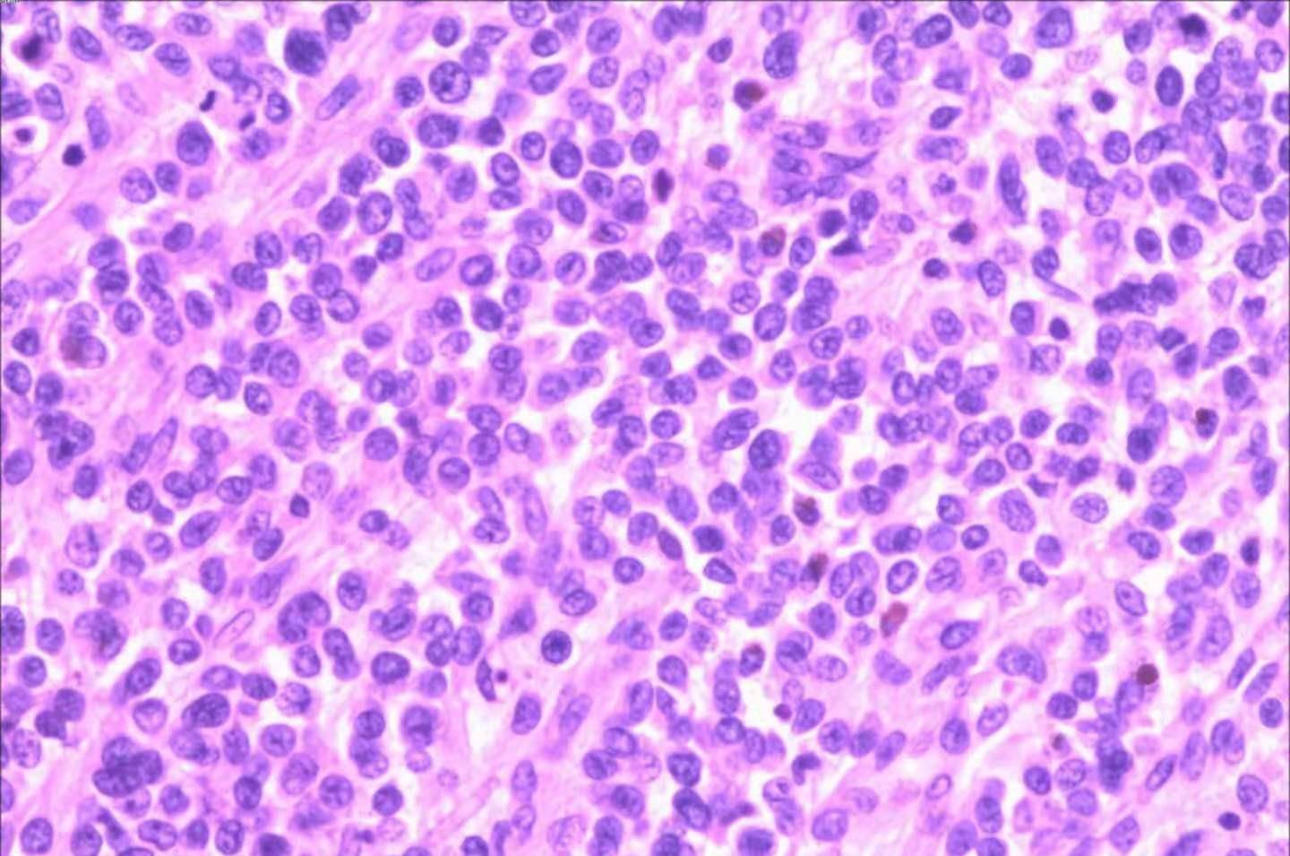 诊治|限制性心肌病，心肌病中最罕见的类型，其诊治手段有哪些呢？