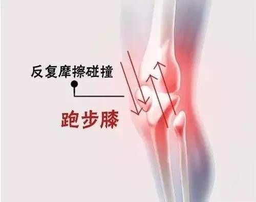 和运动的主要关节由于膝盖关节复杂最为常见以膝盖前方和膝盖外侧疼痛