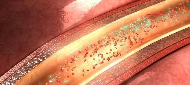 他汀|我对那个动脉有斑块的人说,最好不要停用他汀,原因是什么?